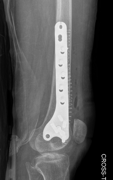 Distal Femur Plate 2